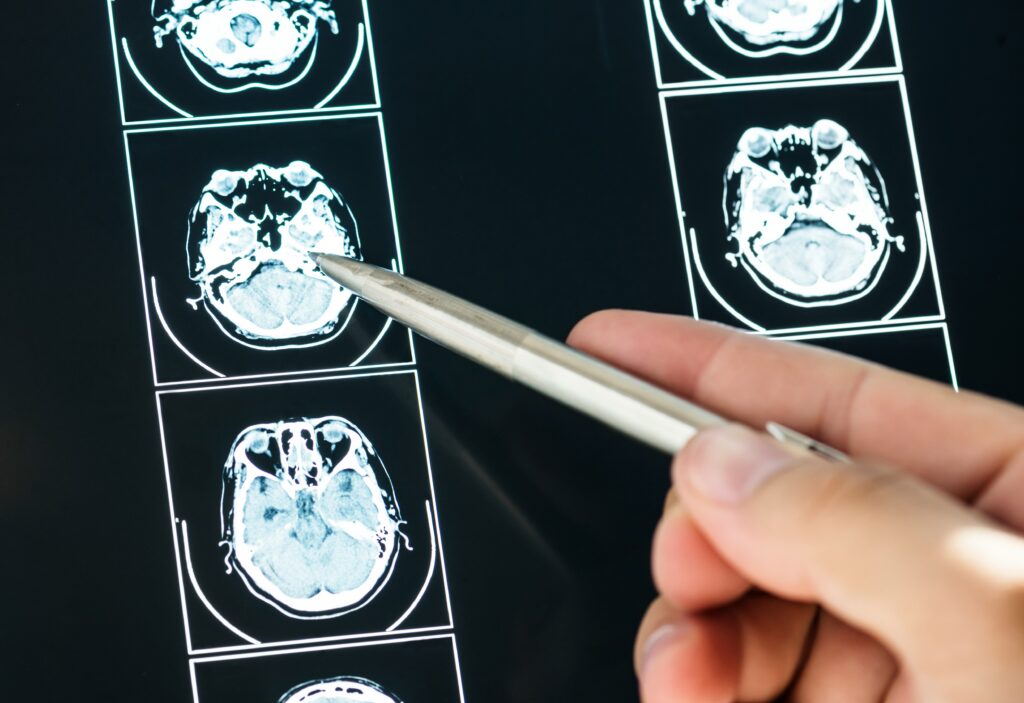 Close up of person using pen to point at MRI brain scans. 