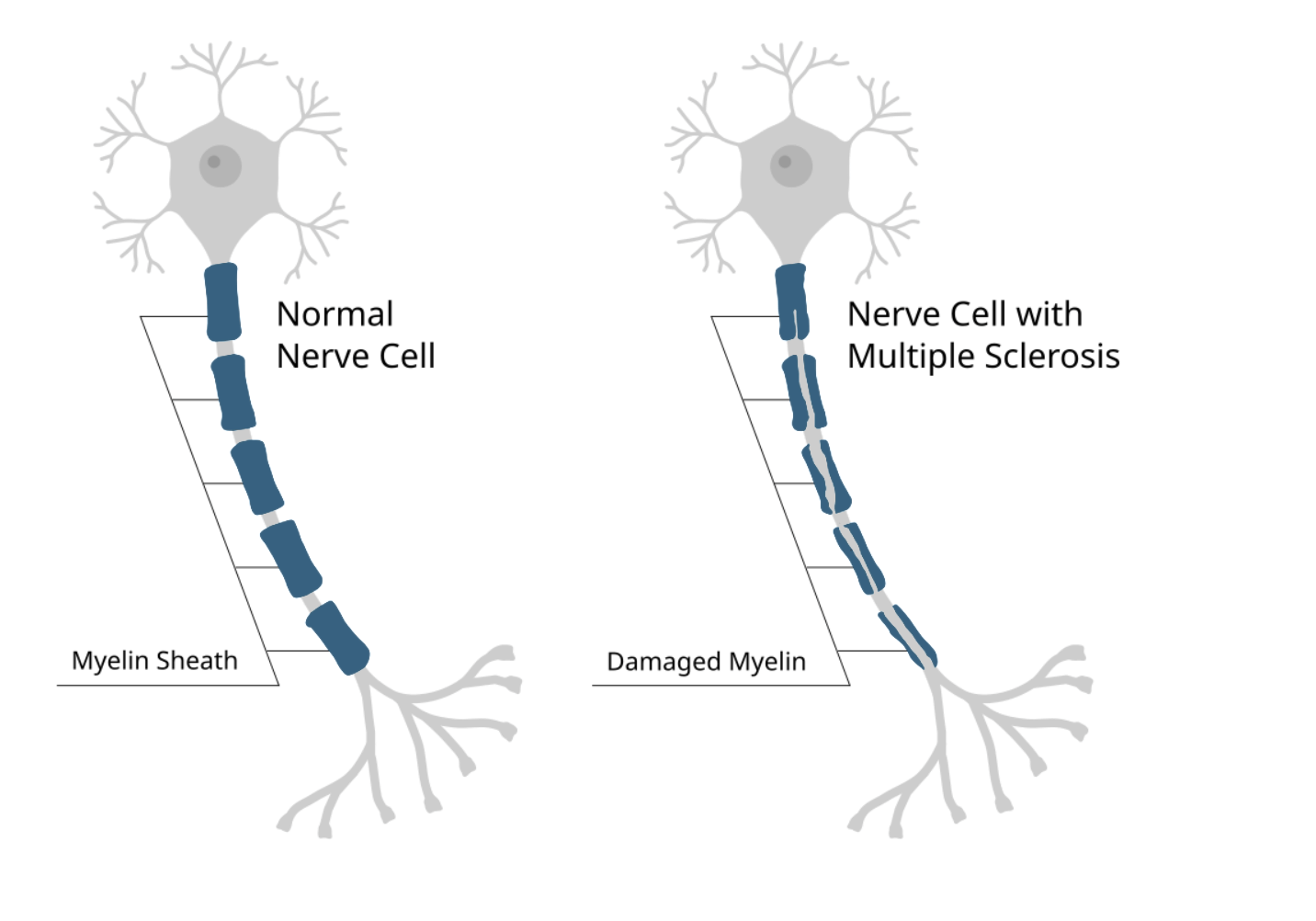 An illustration of a normal nerve cell compared to a nerve cell with Multiple Sclerosis.